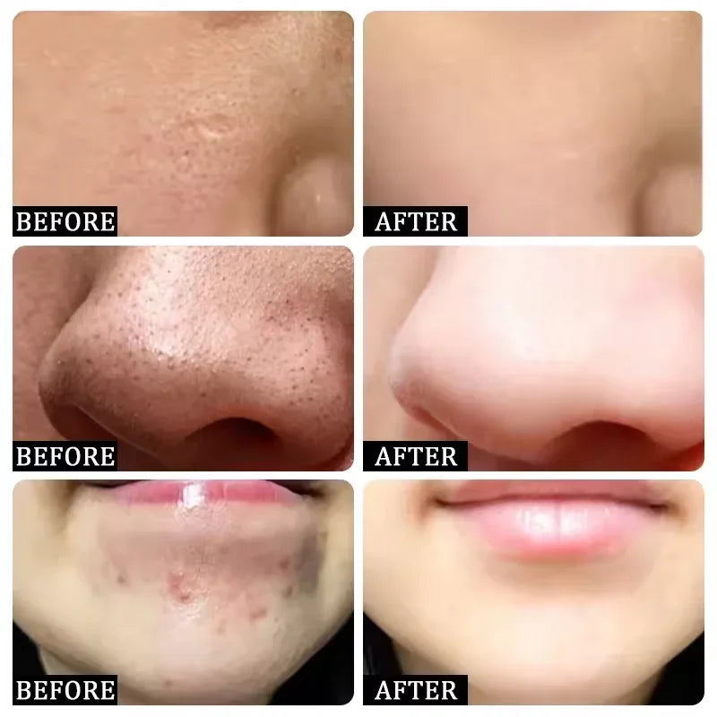 Pore Shrinking Cream – 1pc

💰 Price: €12.99
🧴 Reduces large pores & blackheads.
🌿 Repairs acne scars & tightens skin.
✨ Smooth, clear & fresh look.