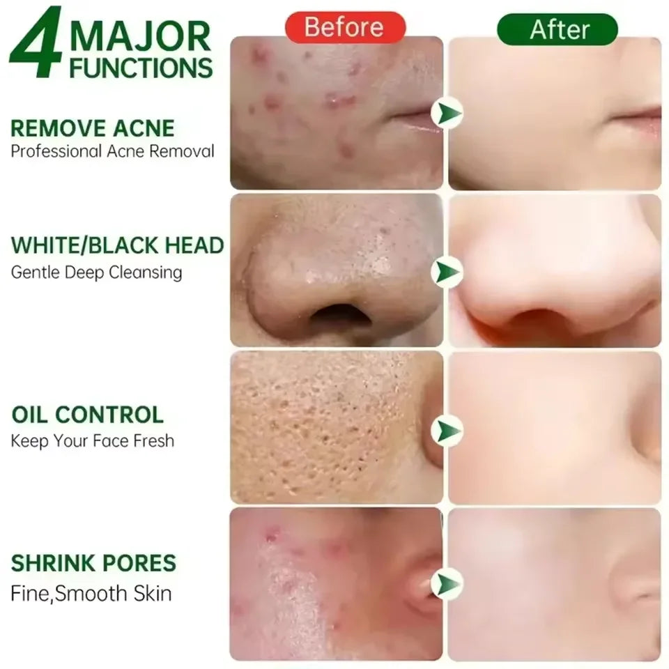 Pore Shrinking Cream – 1pc

💰 Price: €12.99
🧴 Reduces large pores & blackheads.
🌿 Repairs acne scars & tightens skin.
✨ Smooth, clear & fresh look.